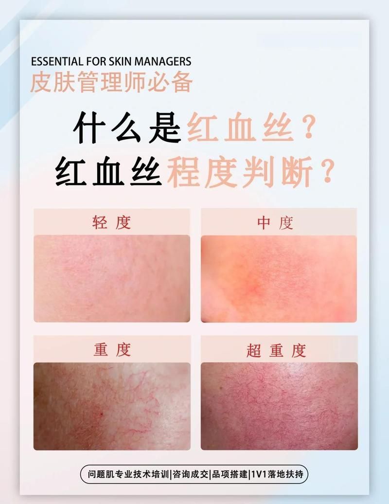 如何判斷紅血絲是否嚴重，如何判斷紅血絲嚴重