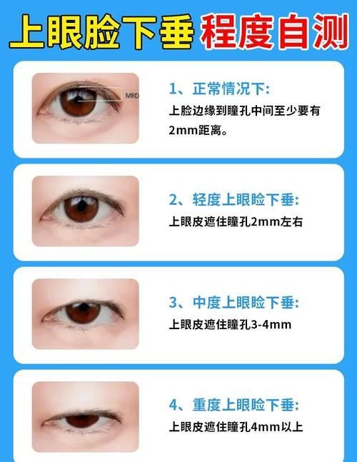 如何判斷自己是否掉眼，如何判斷上瞼下垂