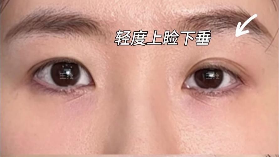 如何判斷自己是否掉眼，如何判斷上瞼下垂
