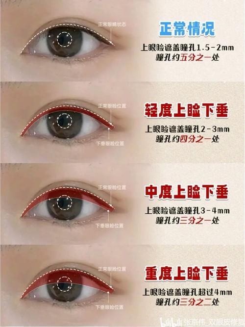 如何判斷自己是否掉眼，如何判斷上瞼下垂