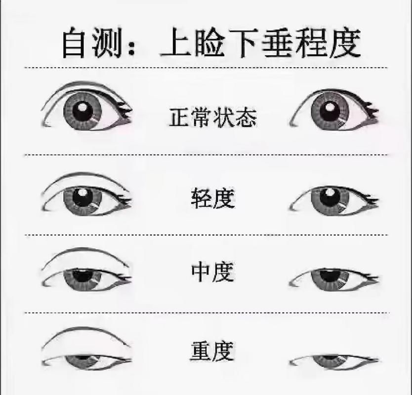 如何判斷自己是否掉眼，如何判斷上瞼下垂