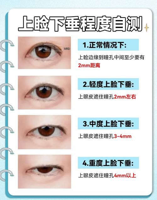 如何判斷自己是否掉眼，如何判斷上瞼下垂