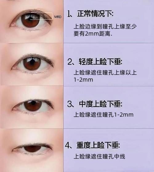 如何判斷自己是否掉眼，如何判斷上瞼下垂