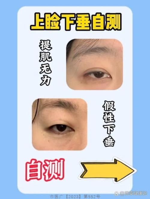 如何判斷自己是否掉眼，如何判斷上瞼下垂