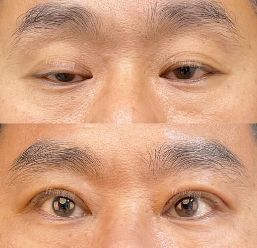 如何判斷自己是否掉眼，如何判斷上瞼下垂