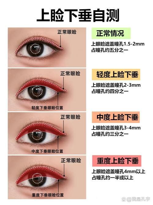 如何判斷自己是否掉眼，如何判斷上瞼下垂