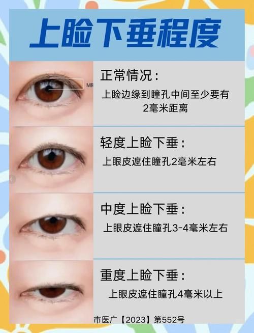 如何判斷自己是否掉眼，如何判斷上瞼下垂