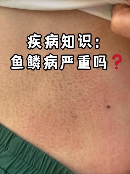 魚立鱗病最嚴(yán)重圖片，魚立鱗病最嚴(yán)重圖片展示