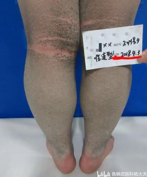 魚立鱗病最嚴(yán)重圖片，魚立鱗病最嚴(yán)重圖片展示
