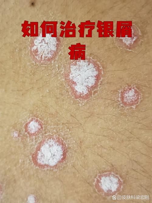 如何判斷炸鱗病是否復發(fā)，如何判斷銀屑病復發(fā)