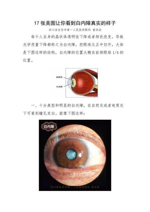 蒙眼病有哪些癥狀，“蒙眼病”有哪些癥狀用戶要求詳細解釋“蒙眼病”的癥狀