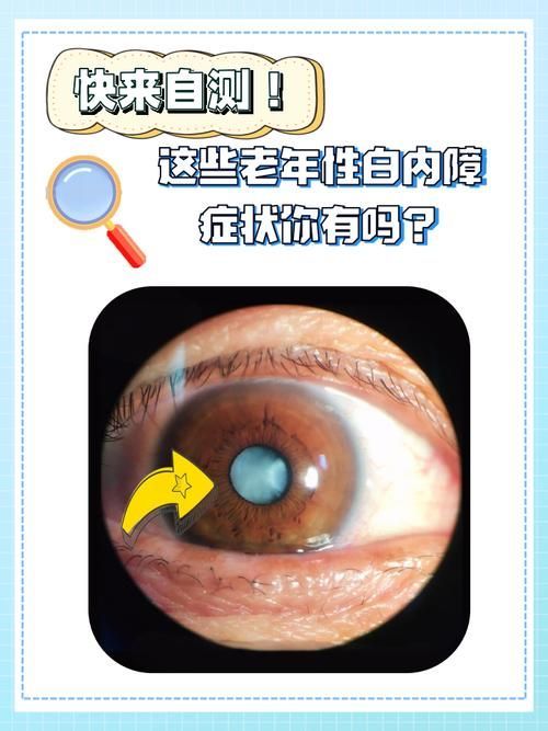 蒙眼病有哪些癥狀，“蒙眼病”有哪些癥狀用戶要求詳細解釋“蒙眼病”的癥狀