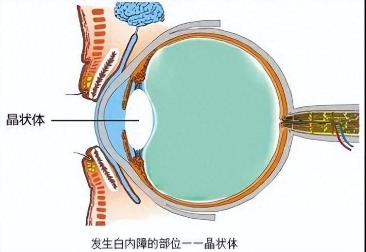 蒙眼病有哪些癥狀，“蒙眼病”有哪些癥狀用戶要求詳細解釋“蒙眼病”的癥狀