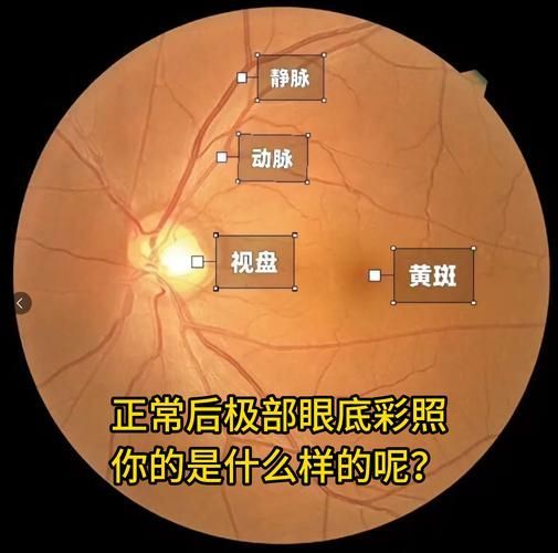 蒙眼病有哪些癥狀，“蒙眼病”有哪些癥狀用戶要求詳細解釋“蒙眼病”的癥狀