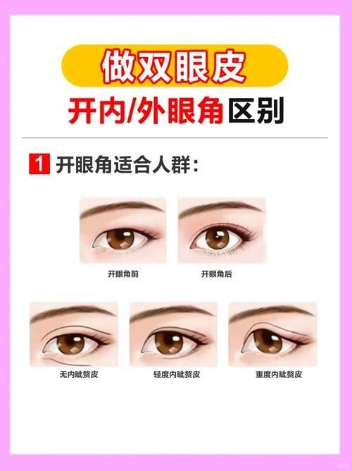 如何區(qū)分外蒙眼和內(nèi)蒙眼，“內(nèi)蒙眼”并非標(biāo)準(zhǔn)醫(yī)學(xué)術(shù)語