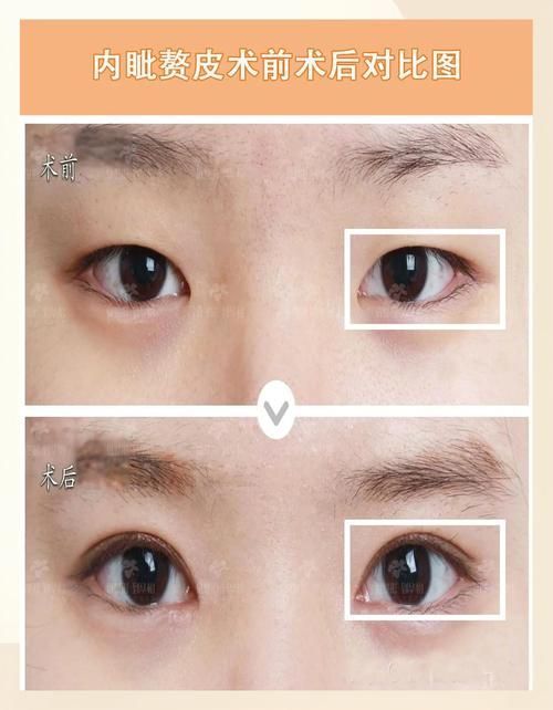 如何區(qū)分外蒙眼和內(nèi)蒙眼，“內(nèi)蒙眼”并非標(biāo)準(zhǔn)醫(yī)學(xué)術(shù)語