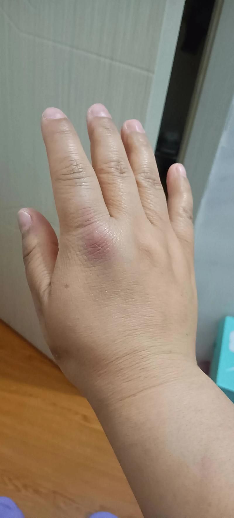 魚咬傷后多久會恢復(fù)，百度健康-去問診魚咬傷后多久會恢復(fù)思考完成