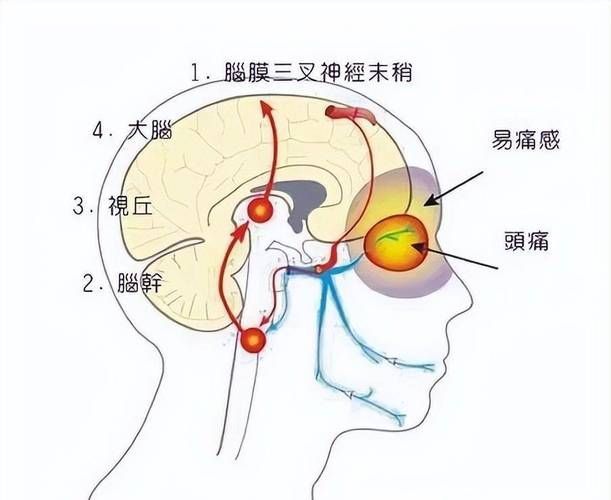 哪種治療方法最適合我，中華醫(yī)學(xué)會《中國偏頭痛診斷與治療指南》1000字詳解