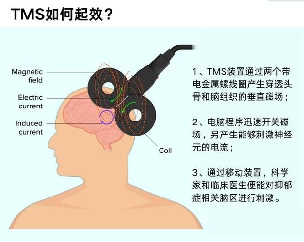 哪種治療方法最適合我，中華醫學會《中國偏頭痛診斷與治療指南》1000字詳解