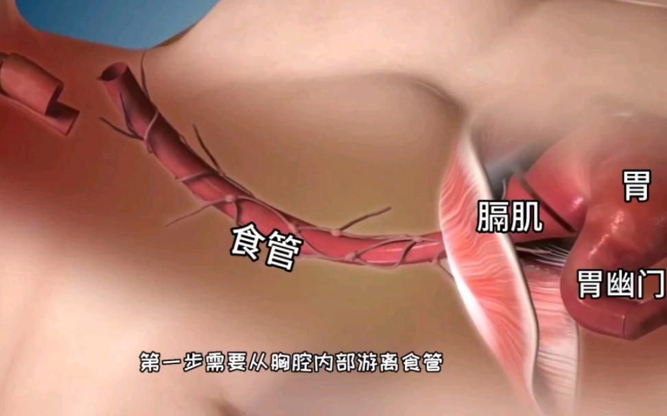 能詳細解釋每個手術步驟的含義嗎，微創腹腔鏡膽囊切除手術