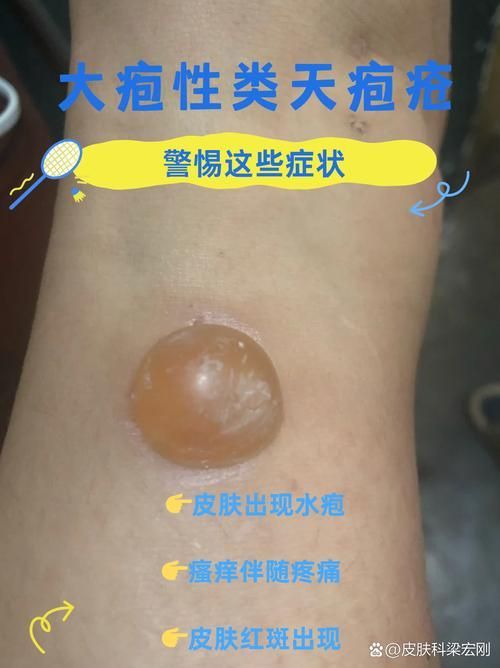 爛身病有哪些癥狀，\