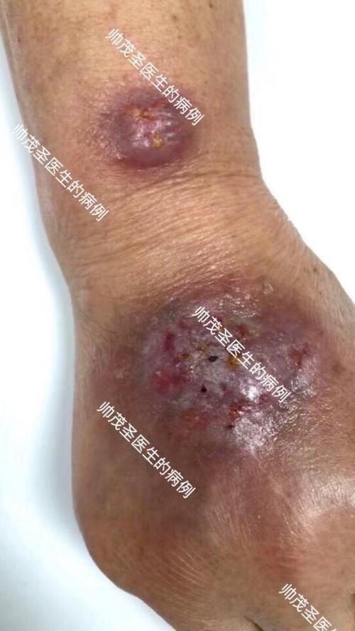 小火龍魚接觸后會有哪些癥狀？，小火龍魚修剪魚鰭、被鰭刺傷是怎么回事？