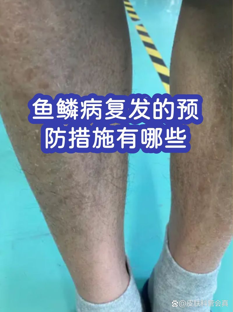 如何預(yù)防魚鱗腐爛復(fù)發(fā)，如何預(yù)防魚鱗病復(fù)發(fā)