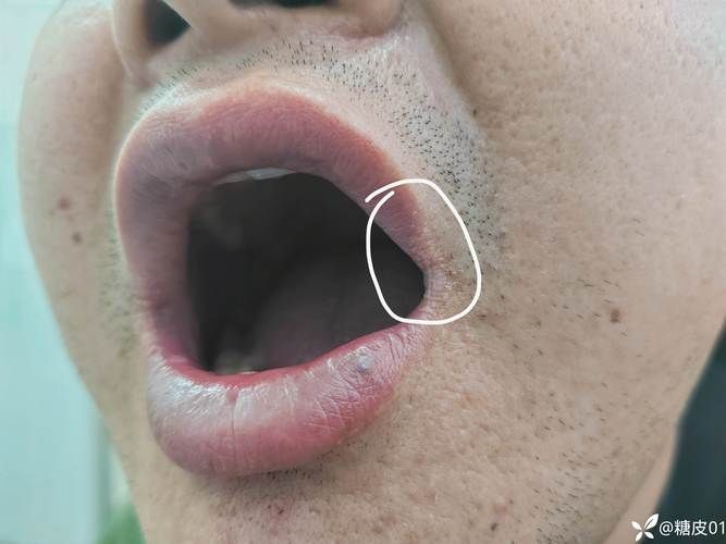如何治療魚嘴凸起白色包，如何治療“魚嘴凸起白色包”