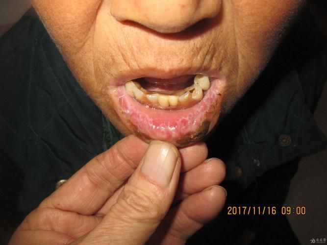 如何治療魚嘴凸起白色包，如何治療“魚嘴凸起白色包”