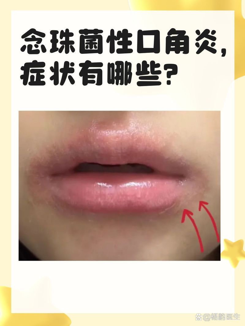 如何治療魚嘴凸起白色包，如何治療“魚嘴凸起白色包”