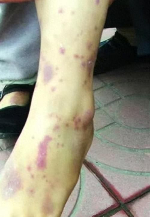 如何區分物理損傷和細菌性出血病，如何區分物理損傷與細菌性出血病