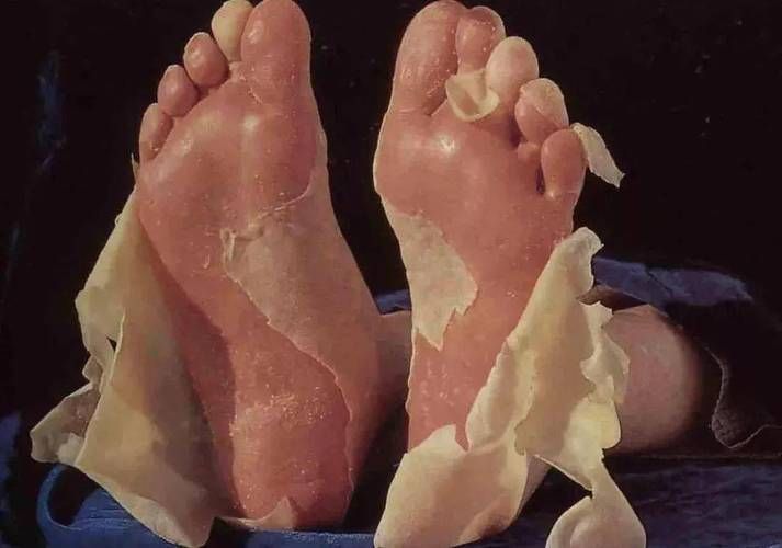 魚鱗病和松鱗病哪個(gè)更難治療
