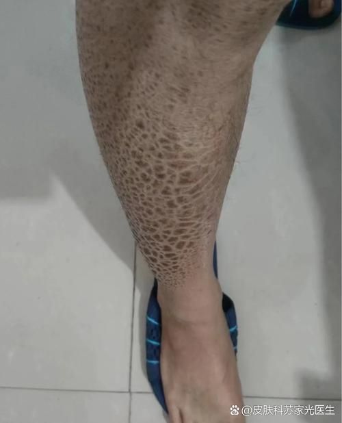 魚鱗腐爛最快解決方法，浴鱗腐爛最快解決方法