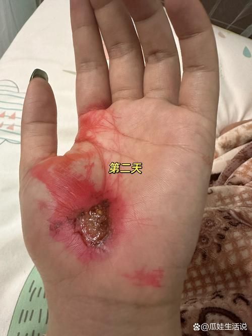 傷口感染后如何治療，傷口感染后的處理