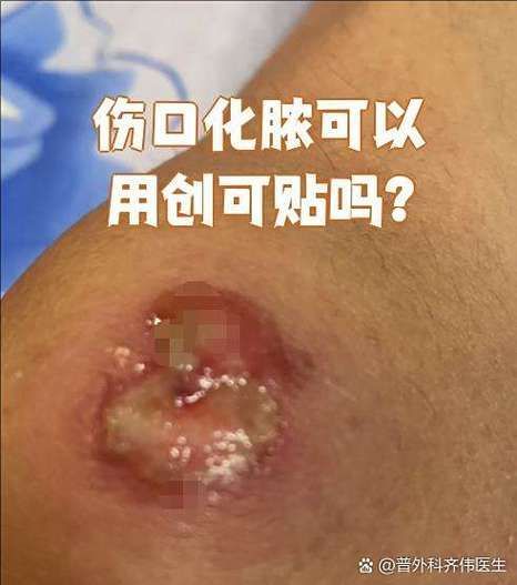 傷口感染后如何治療，傷口感染后的處理