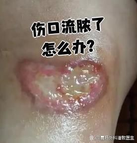 傷口感染后如何治療，傷口感染后的處理
