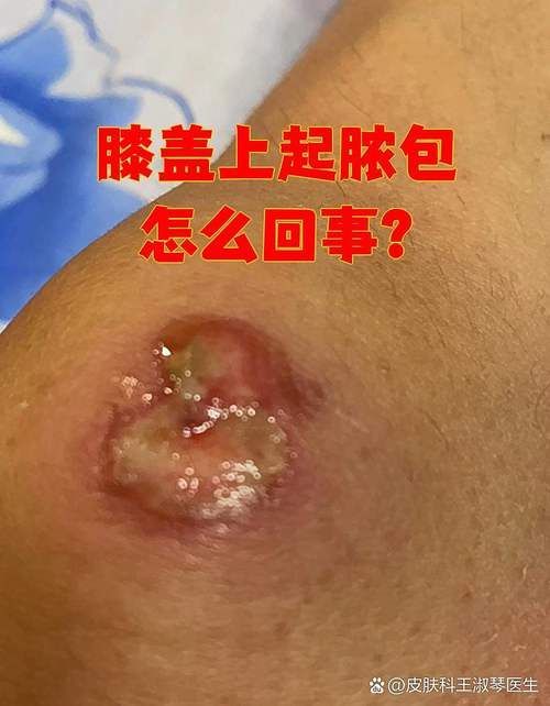 傷口感染后如何治療，傷口感染后的處理