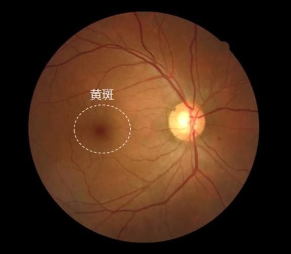 蒙眼病有哪些癥狀，“蒙眼病”并非醫學術語并非醫學術語并非醫學術語