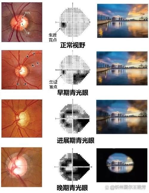 蒙眼病有哪些癥狀，“蒙眼病”并非醫學術語并非醫學術語并非醫學術語
