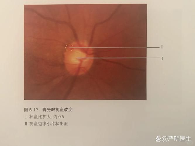 蒙眼病有哪些癥狀，“蒙眼病”并非醫學術語并非醫學術語并非醫學術語
