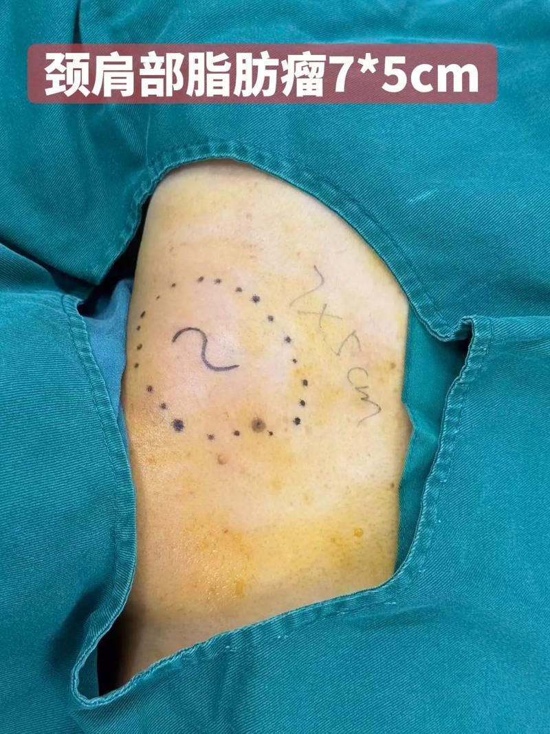 手術治療贅生物的風險有多大，手術治療贅生物手術治療贅生物的風險有多大思考完成