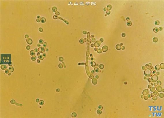 如何判斷蒙眼病是否由真菌引起，一步召回真菌性角膜炎