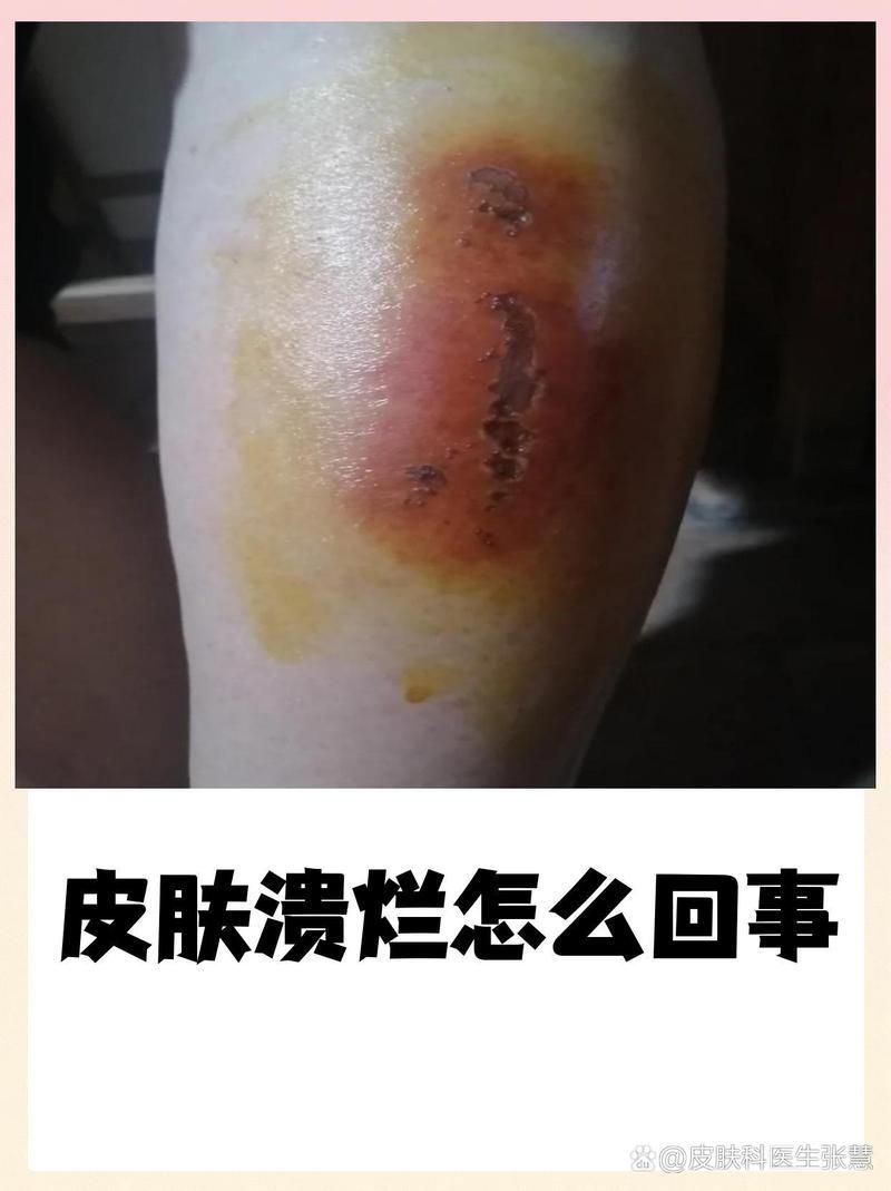 潰爛病有哪些治療方法，潰爛病治療方法