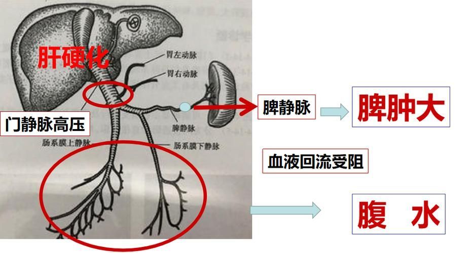 雷龍腹水患者應該如何護理，雷龍腹水患者如何護理