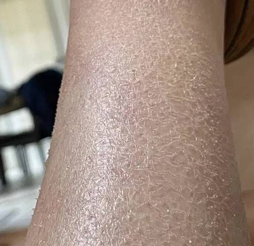 如何判斷松鱗病是否好轉
