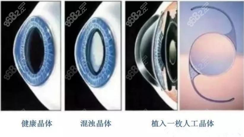蒙眼病治療需要多長時間，“蒙眼病治療需要多長時間對比圖、角膜炎治療需要多長時間”