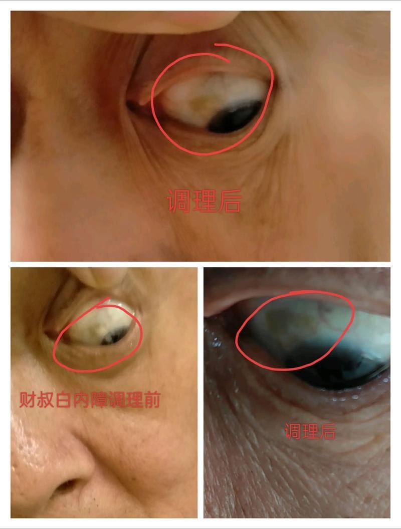 蒙眼病治療需要多長時間，“蒙眼病治療需要多長時間對比圖、角膜炎治療需要多長時間”