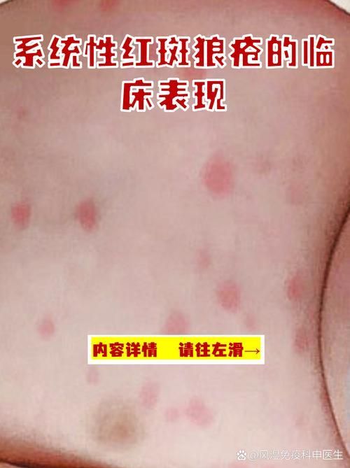 紅斑病和赤皮病有何區別，紅斑病與赤皮病的區別