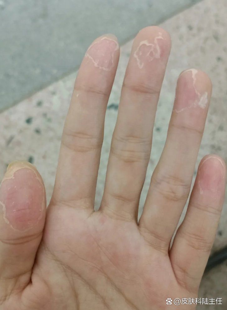 紅斑病和赤皮病有何區別，紅斑病與赤皮病的區別