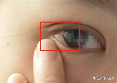 眼睛白膜可以徹底治愈嗎，眼睛白膜可以徹底治愈嗎醫(yī)學(xué)界尚無(wú)確切答案，醫(yī)學(xué)界尚無(wú)確切答案